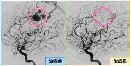 AVM(脳動静脈奇形)への塞栓治療