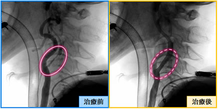 CAS(頸動脈ステント留置術)