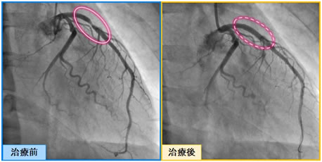 PCI(経皮的冠動脈形成術)